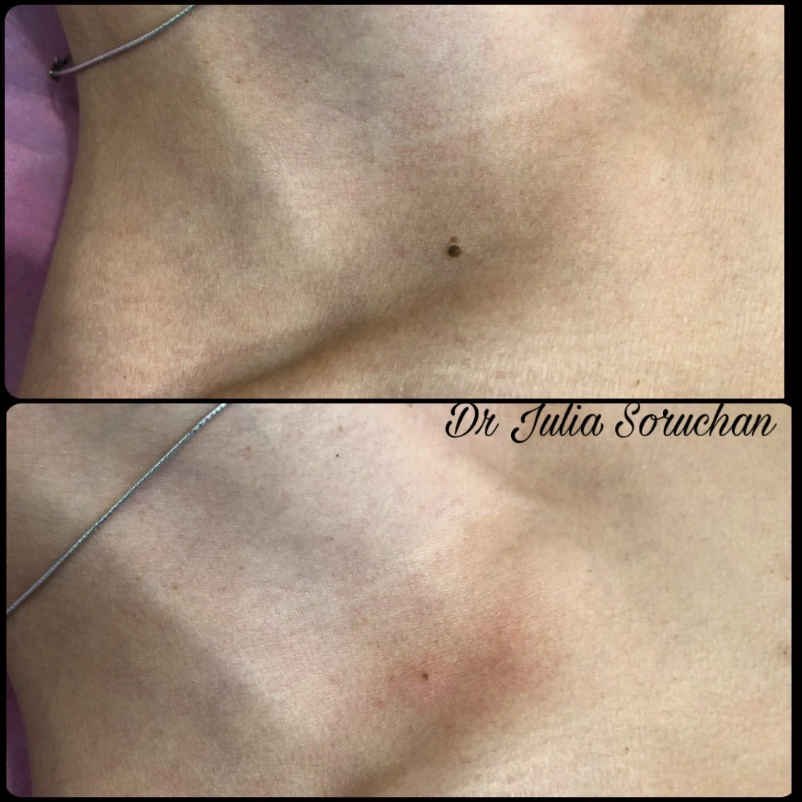 Eliminación de lunar - Antes y Después