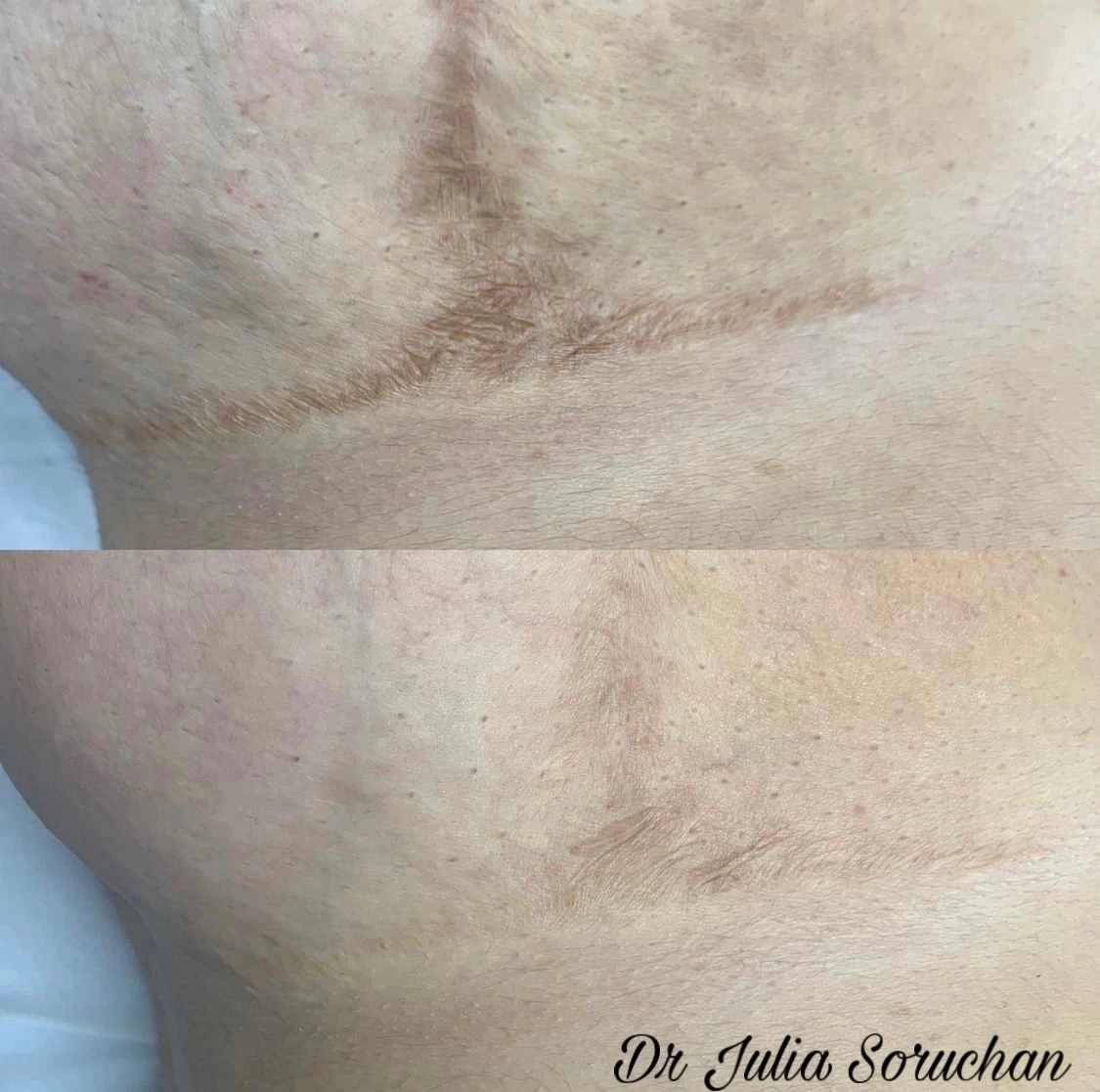 Tratamiento de cicatriz - Antes y Después