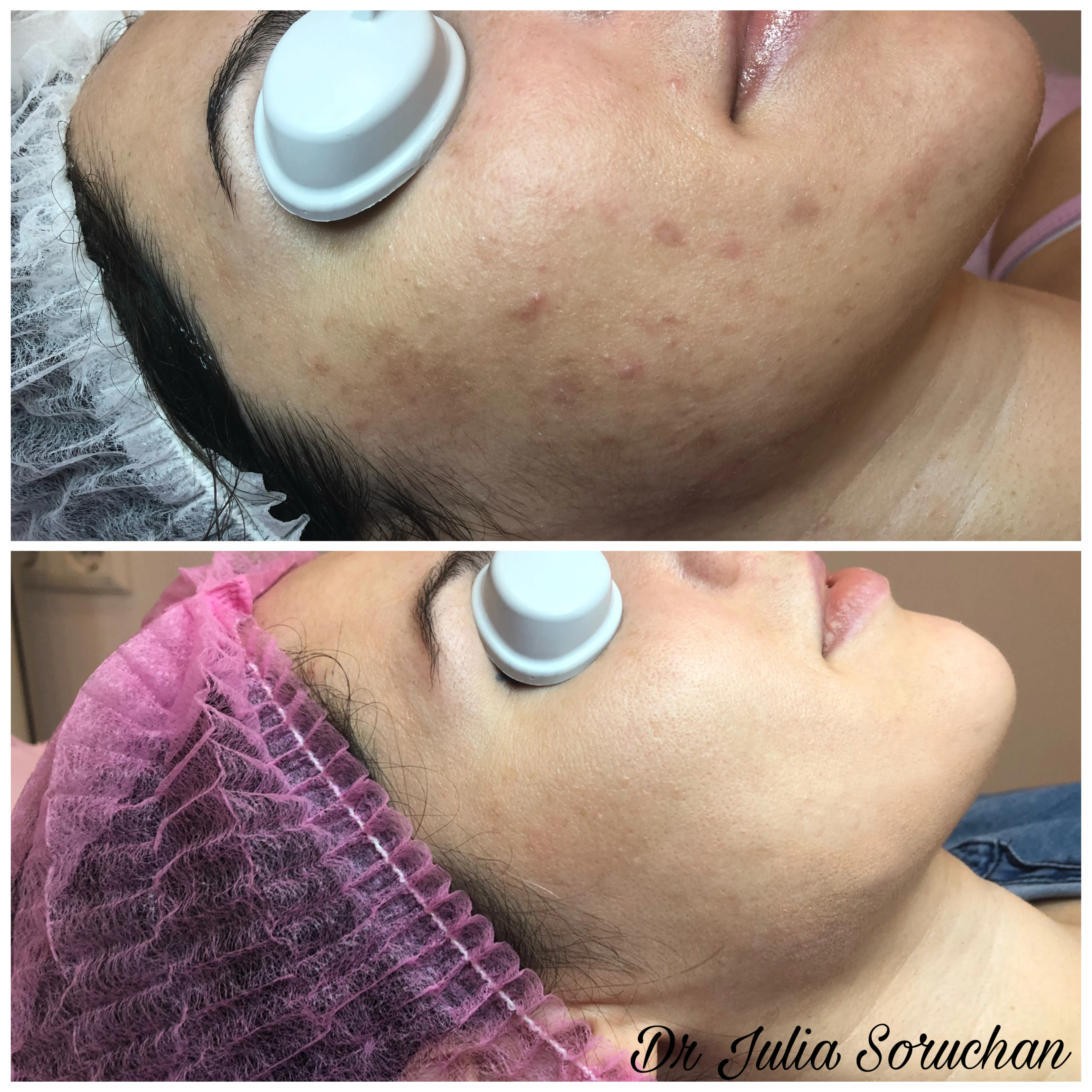 Tratamiento facial - Antes y Después