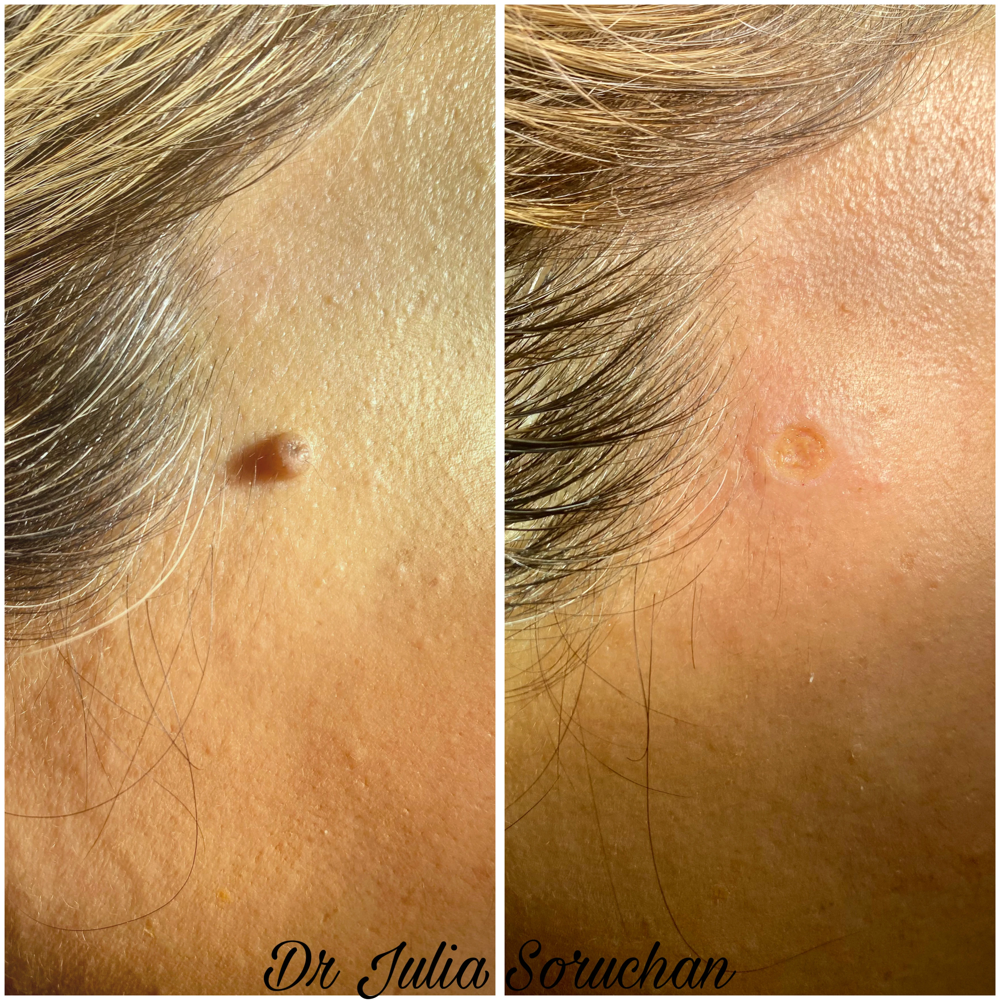 Eliminación de lunar facial - Antes y Después